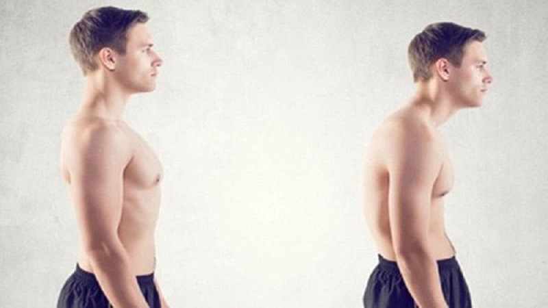 Nguyên nhân gây gù lưng