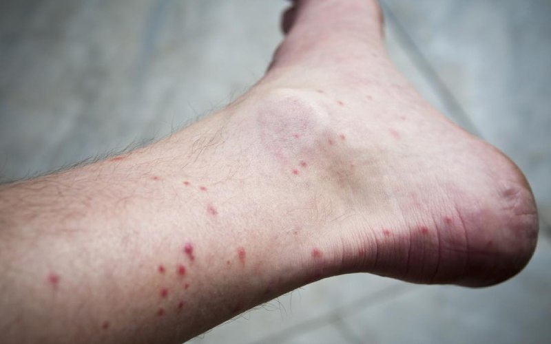 Tiêm vaccine có phòng được cả 4 chủng virus sốt xuất huyết không?