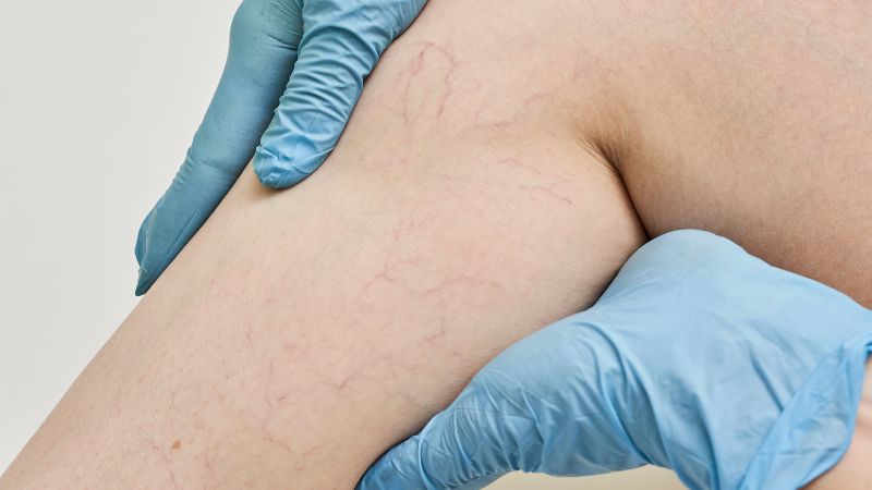 Cải thiện tình trạng sưng phù chân Cải thiện tình trạng sưng phù chân