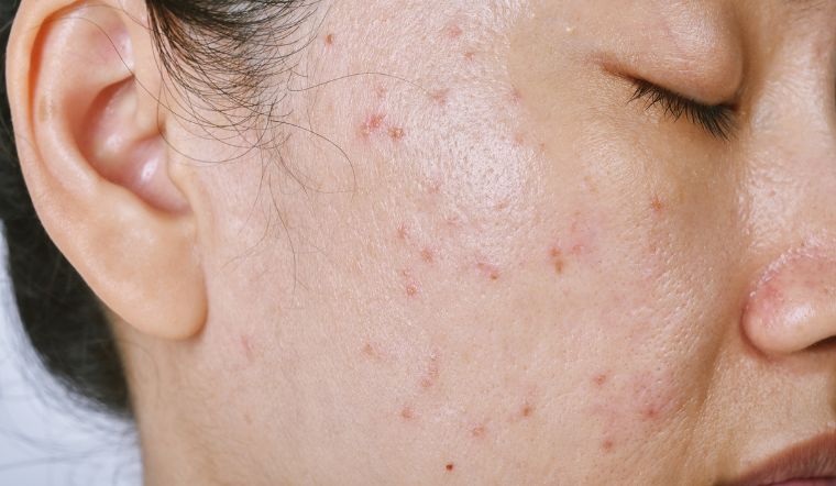 6 cách giảm sợi bã nhờn trên da ngày hè