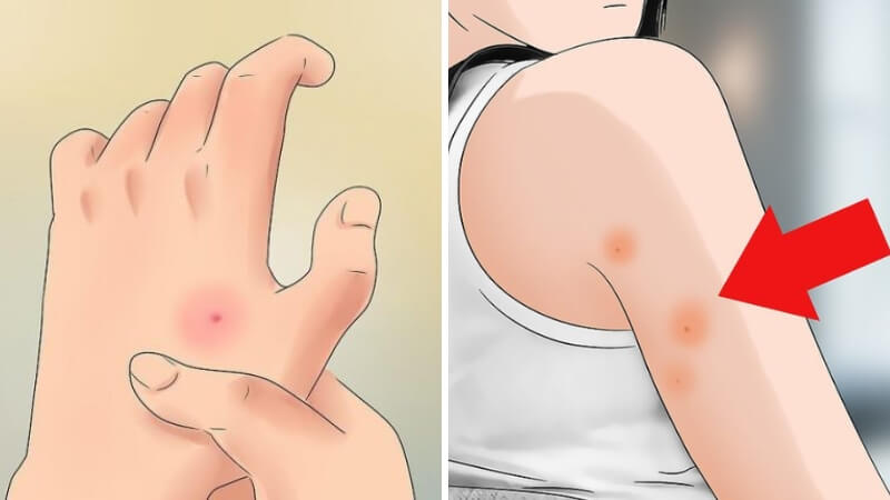 Nên làm gì khi bị nhện nhà cắn