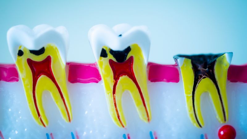 Hội chứng sâu răng do bú bình là gì?