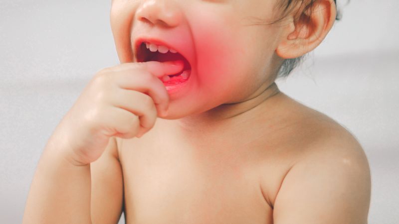 Biểu hiện của hội chứng sâu răng do bú bình