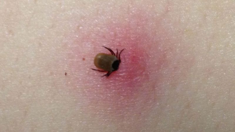 Bệnh Lyme