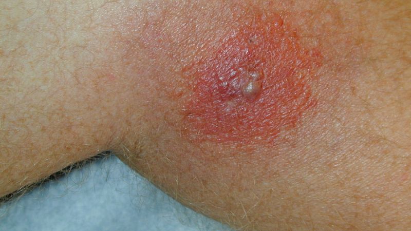 Bệnh Ehrlichiosis