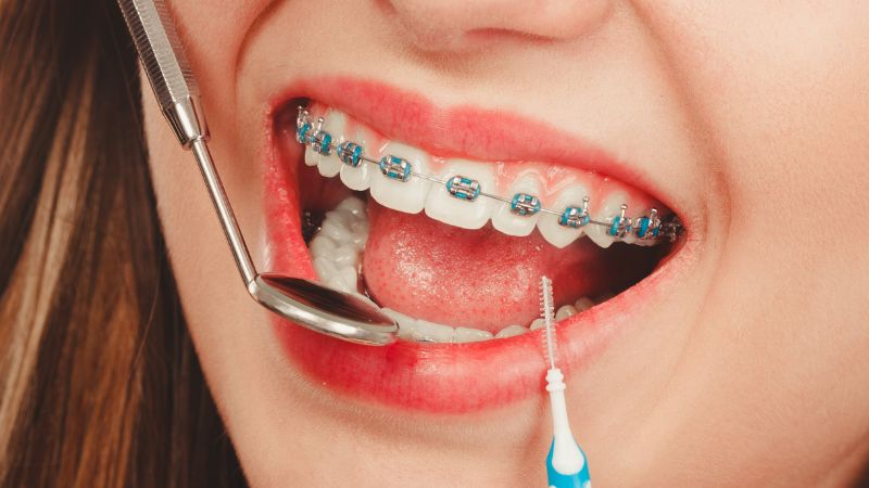 Người 30 tuổi vẫn có thể thực hiện việc niềng răng