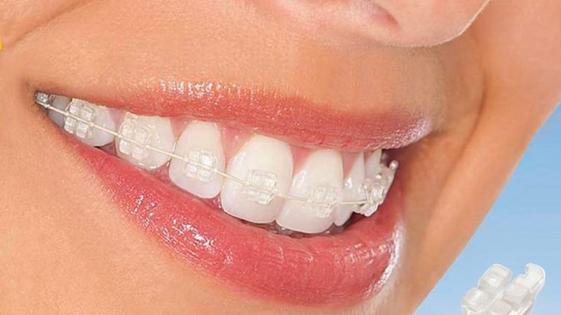 Niềng răng mắc cài sứ