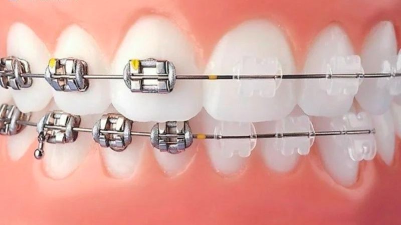 Niềng răng mắc cài tự khóa