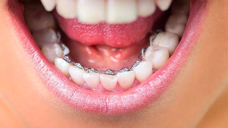 Niềng răng mắc cài mặt trong