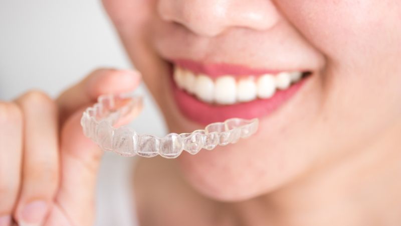 Niềng răng trong suốt