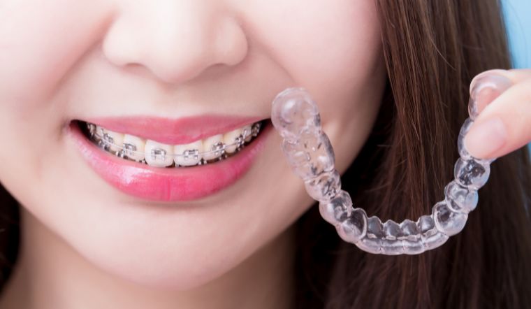 30 tuổi niềng răng được không? Tìm hiểu độ tuổi niềng răng hợp lý