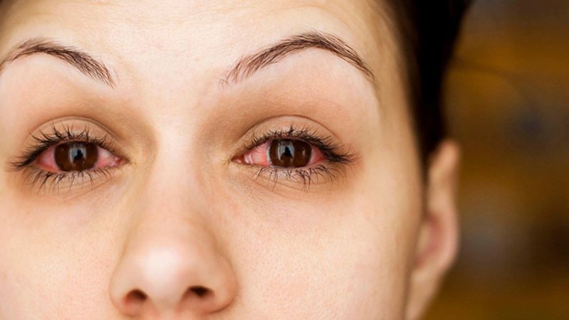 Bệnh đau mắt đỏ khi mang thai là gì?