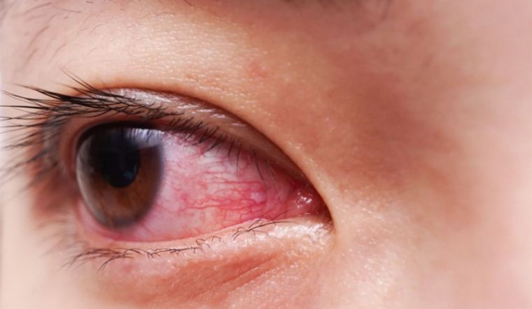 Đau mắt đỏ gây ra tình trạng đỏ mắt