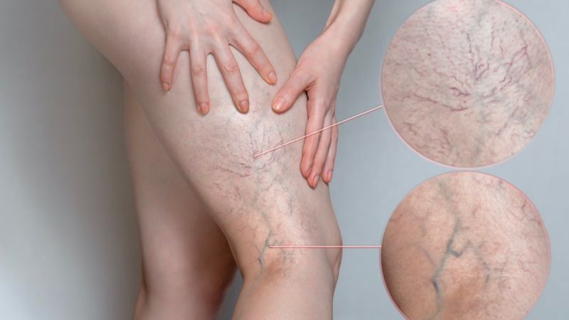 Suy giãn tĩnh mạch ở chân là gì? Suy giãn tĩnh mạch ở chân là gì?