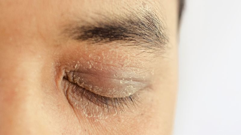 Những dấu hiệu khô vùng da quanh mắt