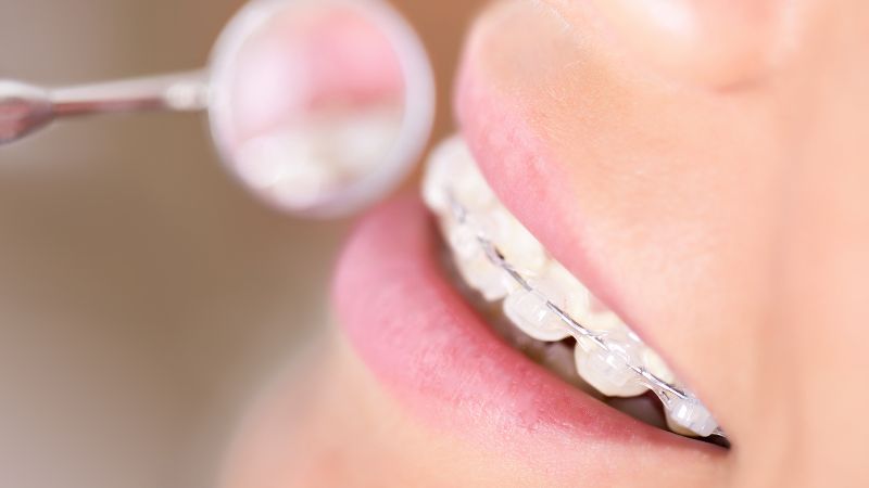 Răng đã lấy tủy thì bạn vẫn có thể thực hiện phương pháp niềng răng như bình thường