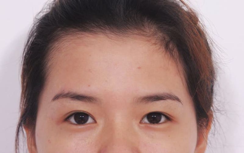 Mắt mí lót gọi là mắt mí ẩn hay mắt mí lận