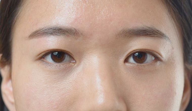 Mắt mí lót là như thế nào? Các cách để khắc phục mắt mí lót