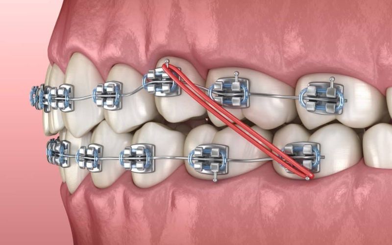 Dây thun niềng răng là một khí cụ quan trọng khi niềng