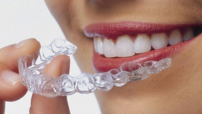 Niềng răng không mắc cài Invisalign