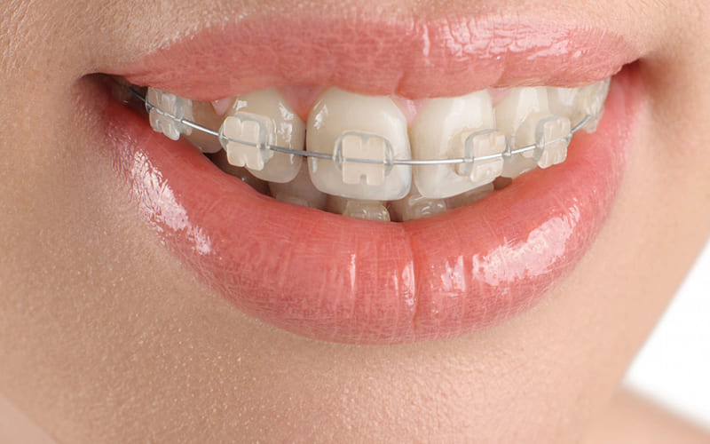 Niềng răng bằng mắc cài sứ là gì?