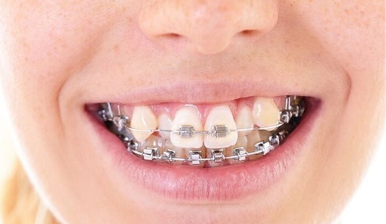 Niềng răng giữ lại răng khểnh có được không? Cần lưu ý gì?