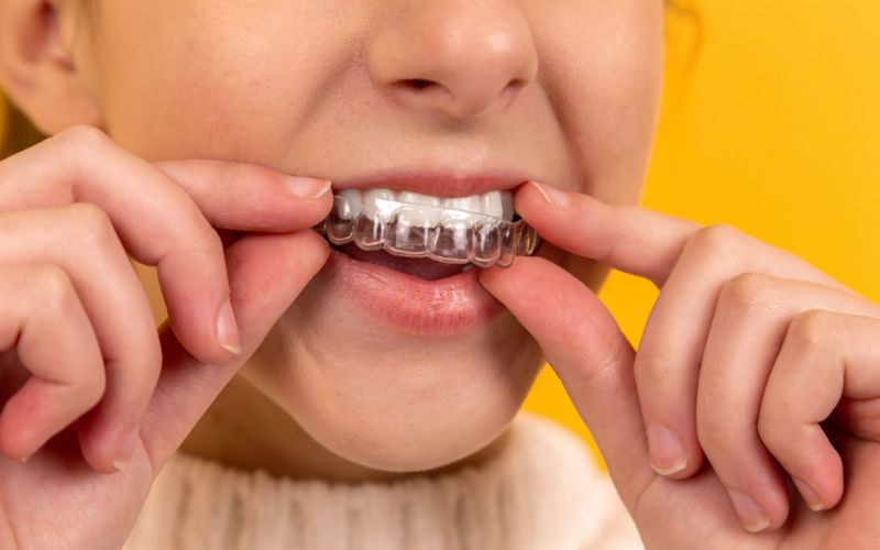 Hàm duy trì là một khí cụ quan trọng trong quá trình niềng răng