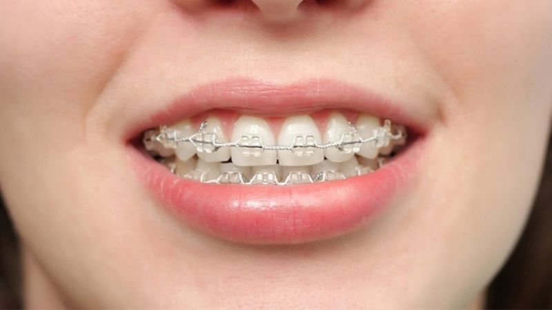 Quy trình niềng răng cơ bản với phương pháp có mắc cài