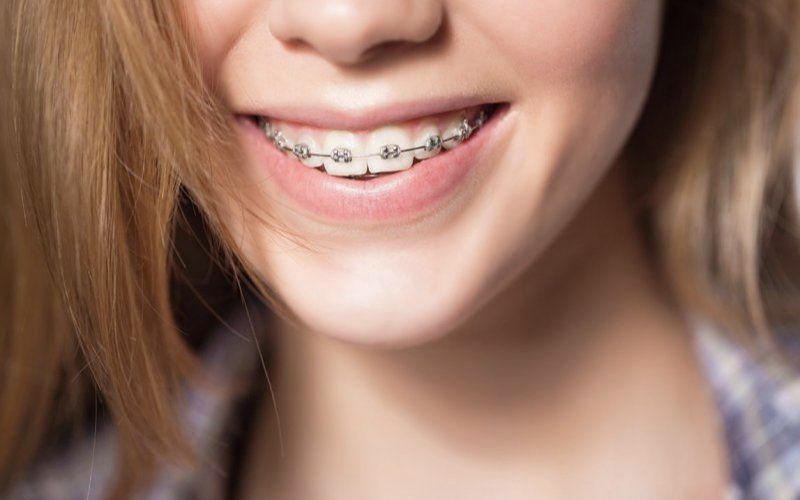 Bạn nên có chế độ ăn uống khoa học để hạn chế sâu răng trong khi niềng răng