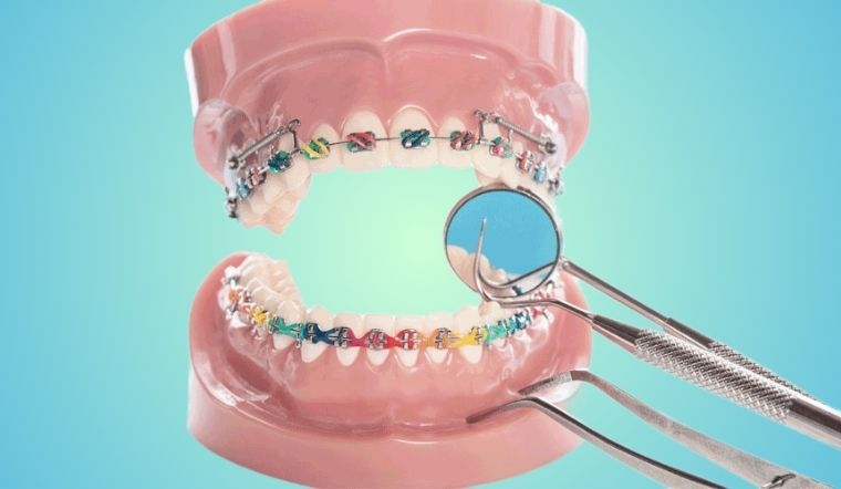 Răng sâu có niềng được không? Cách xử lý răng sâu trước khi niềng răng