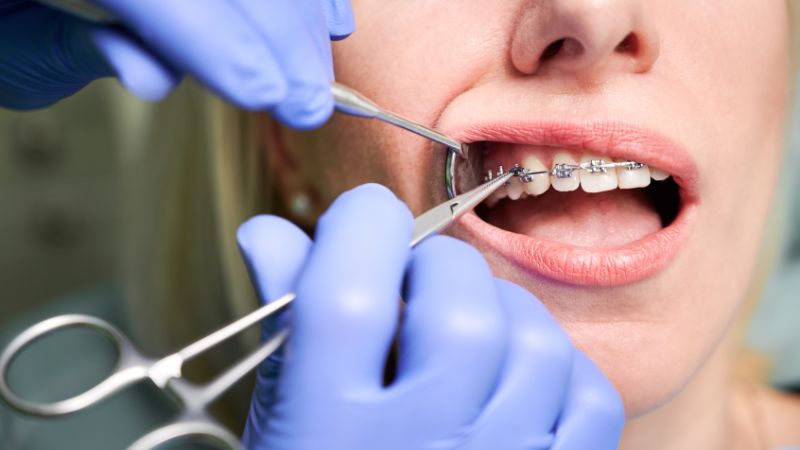 Răng bị lung lay khi niềng có nguy hiểm không?