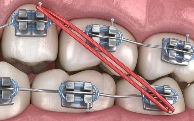 Tác dụng của thun liên hàm khi niềng răng Tác dụng của thun liên hàm khi niềng răng