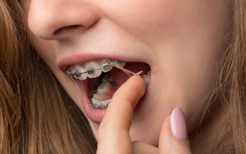 Một số chú ý khi đeo thun liên hàm Một số chú ý khi đeo thun liên hàm