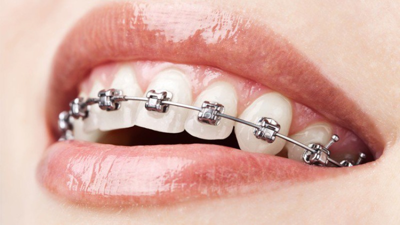 Niềng răng mắc cài kim loại truyền thống là gì?