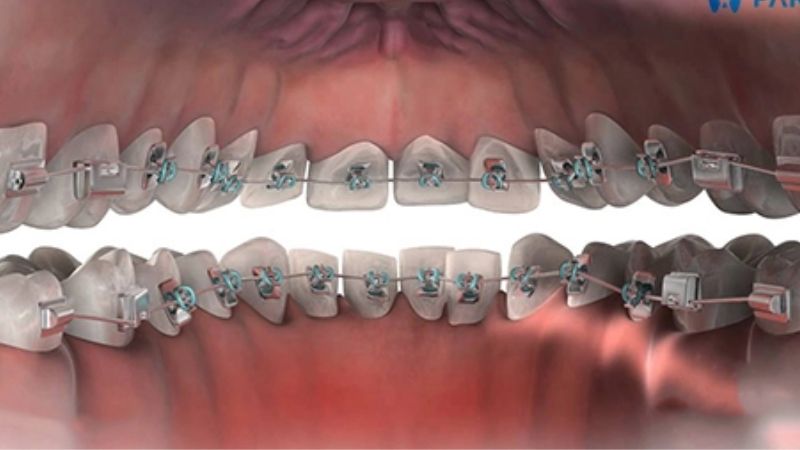 What are Lingual Braces?