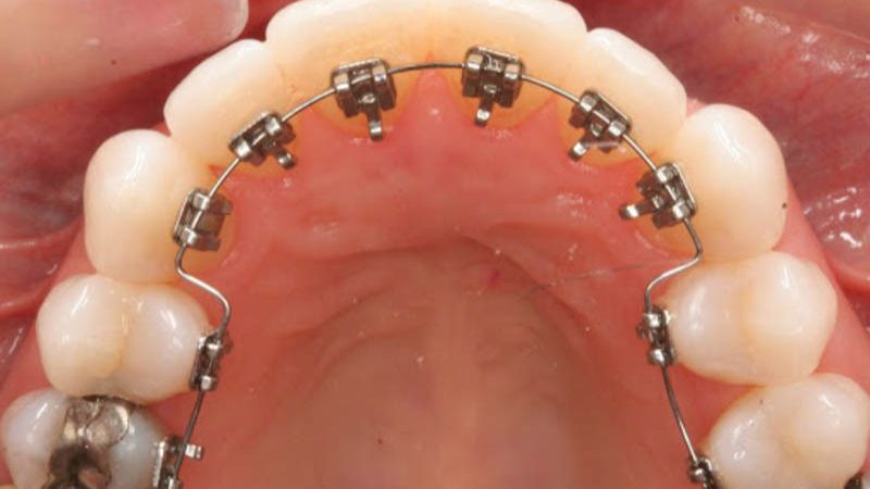 Cases that Require Lingual Braces