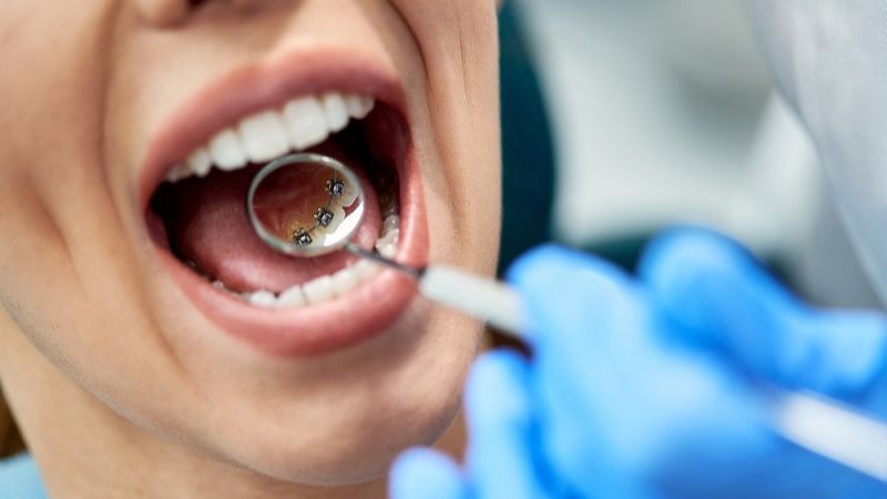 Why are Lingual Braces more expensive than regular braces?