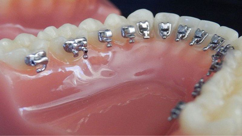 Where to get Lingual Braces? How much does it cost?