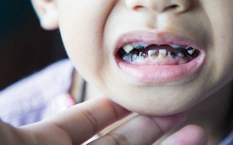 Trẻ bị sún răng sữa phải làm sao? Cách phòng ngừa sún răng sữa cho trẻ