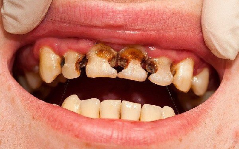 Nguyên nhân khiến trẻ bị sún răng