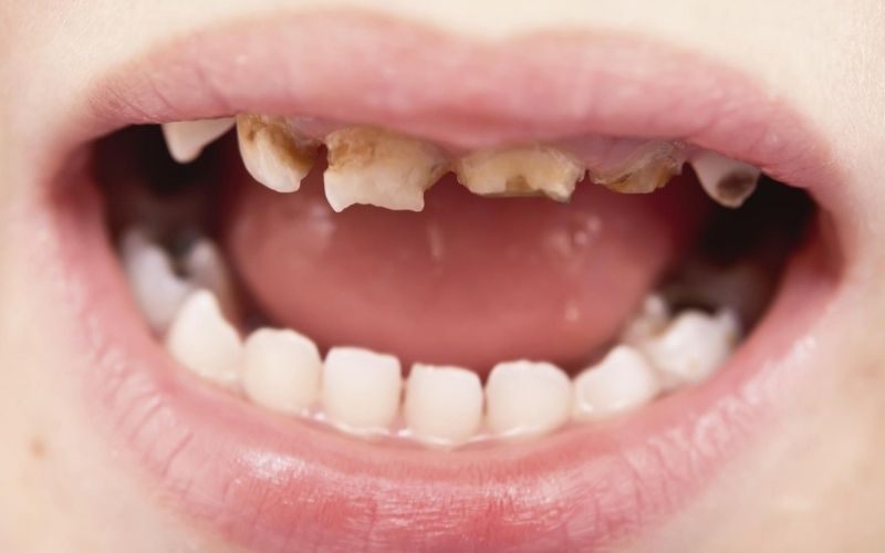 Tác hại khi trẻ bị sún răng