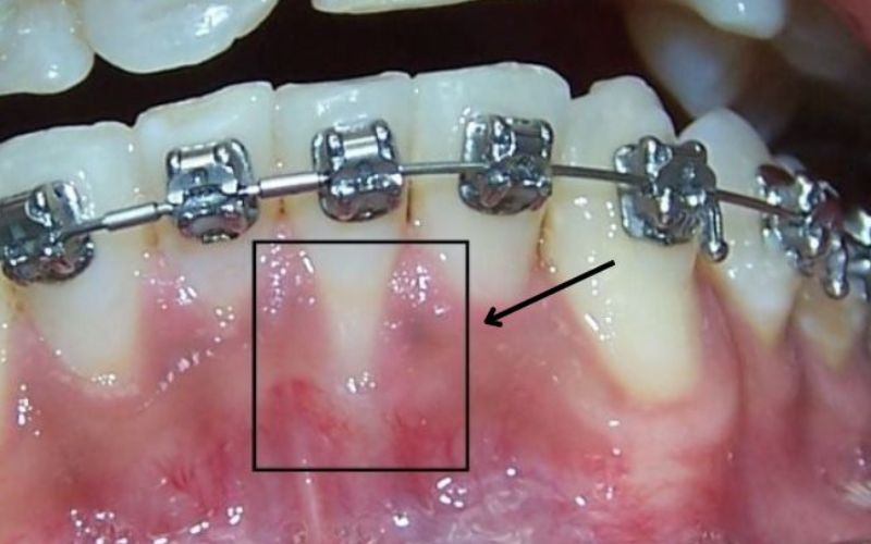 Tụt lợi khi niềng răng vì sao? Cách khắc phục khi niềng răng bị tụt lợi