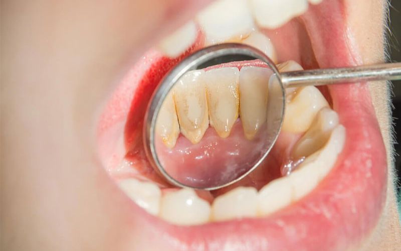 Sự tồn tại của mảng bám cao răng gây ra tụt lợi khi niềng
