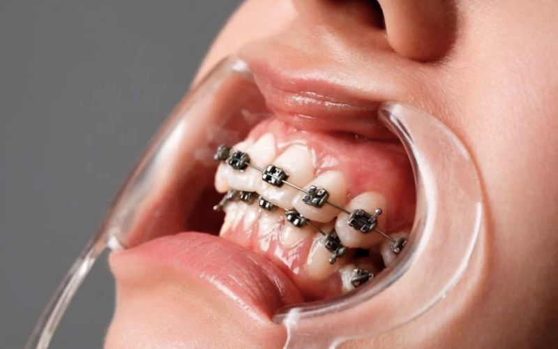Mắc các bệnh lý về răng miệng gây ra tụt lợi khi niềng