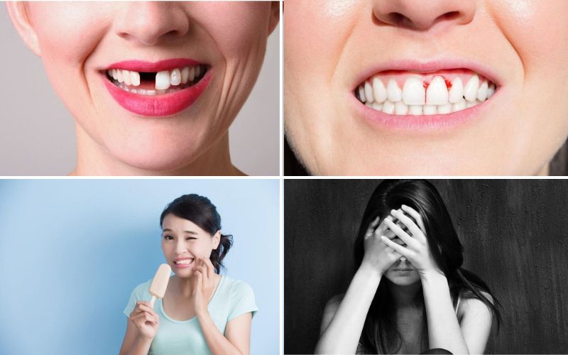Những biến chứng khi niềng răng bị tụt lợi