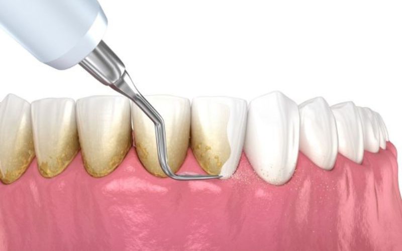 Cách khắc phục khi niềng răng bị tụt lợi nhẹ