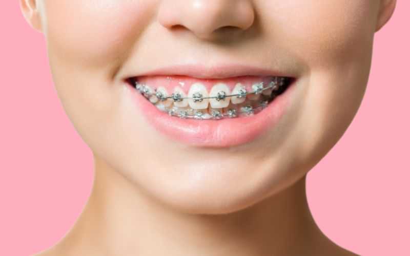 Cách ngăn chặn nguy cơ tụt lợi khi niềng răng