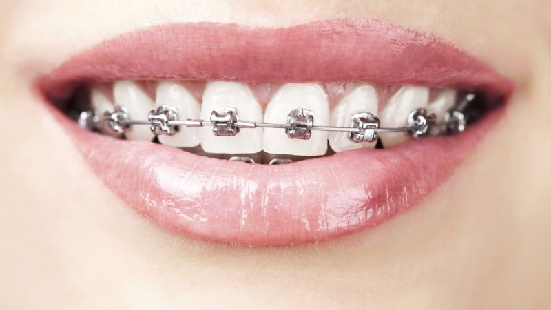 Thời gian niềng răng mắc cài kim loại là bao lâu?