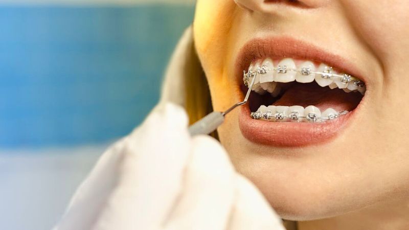 Quy trình niềng răng mắc cài kim loại
