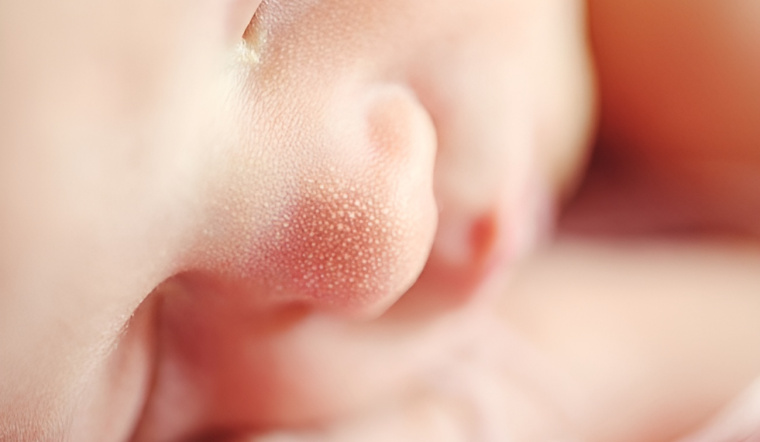 Dấu hiệu mụn hạt kê ở trẻ sơ sinh